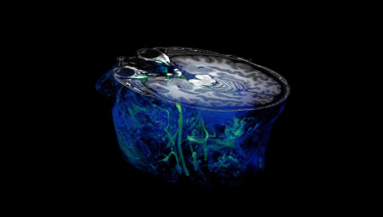 surface rendering of a brain MRI
